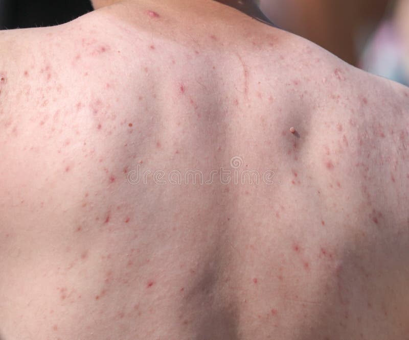 Pimples on the back of a man, Pimples on the back of a man .
