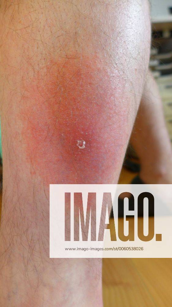 Gefaehrliche Roetung einer Borrelioseinfektion an einem Bein nach Zeckenbiss, Deutschland dangerous flush of an infection of borreliosis at a leg after tick bite, Germany BLWS347229