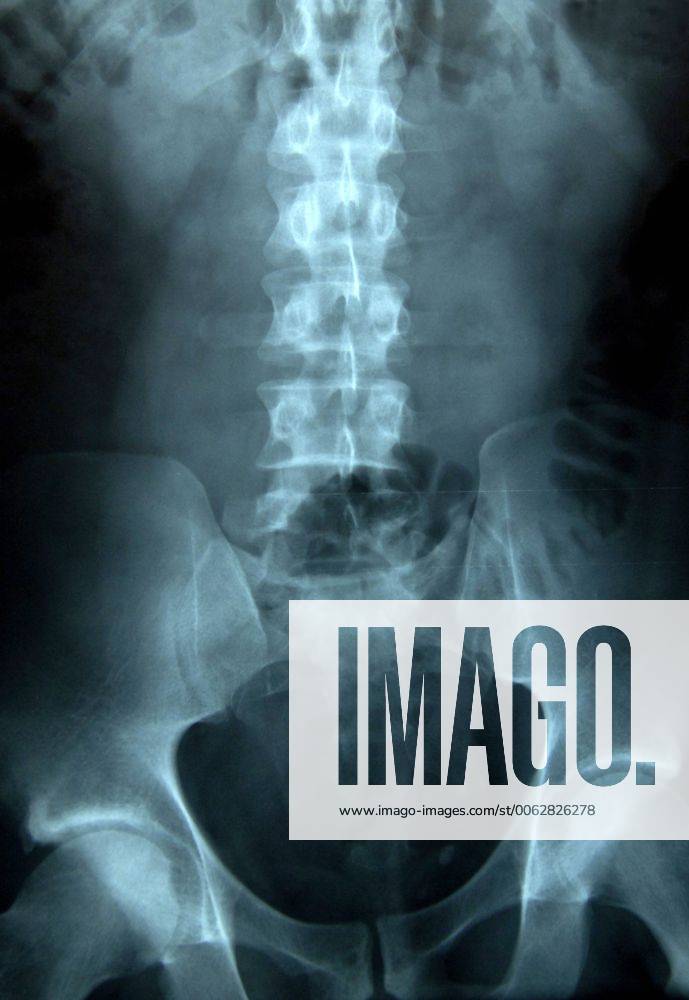 X-Ray of a Female Lumbar Vertibrae