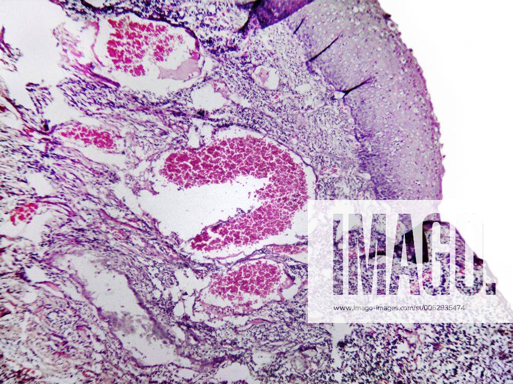 Gewebe von Gebaermutterhalskrebs, mikroskopischer Schnitt, 100-fache Vergroesserung tissue of cervical cancer, 100 x BLWS375877