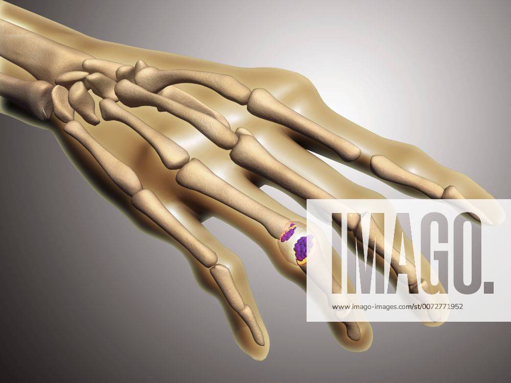 Conceptual image of rheumatoid arthritis (RA) in the human hand. RA is a chronic inflammatory disorder that typically affects the small joints in your hands and feet.