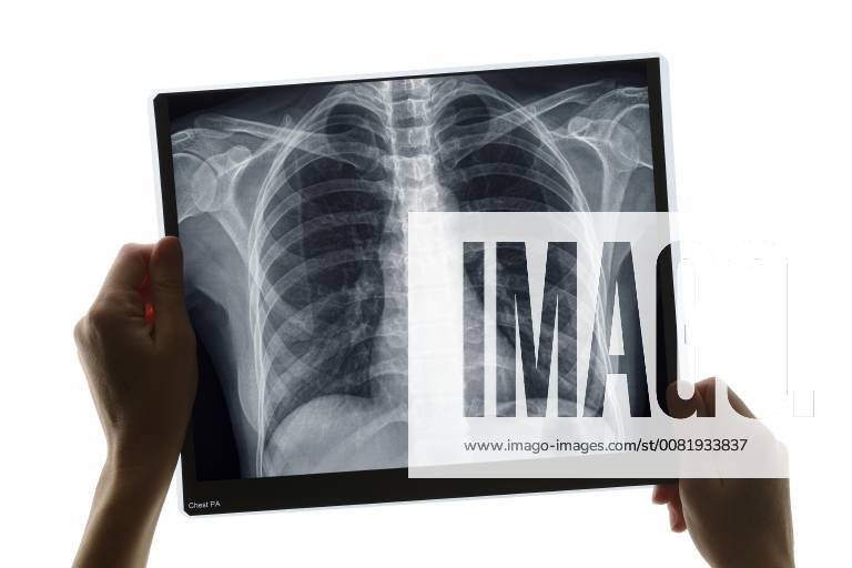 Diagnosis with chest X-ray