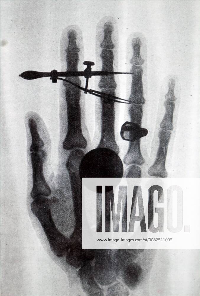 Early Röntgen X-Ray of Wilhelm Röntgen wife s hand. Wilhelm Röntgen (1845-1923) a German mechanical engineer and physicist, who produced and detected electromagnetic radiation in a wavelength range known as X-rays of Röntgen Rays. Dated 19th century 917_05_WHA_102_0062