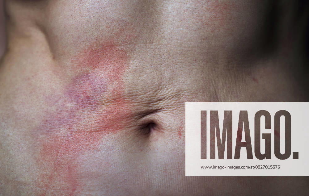 Close up of abdomen with psoriasis redness irritation and scar tissue model released, Symbolfoto, AZF00697