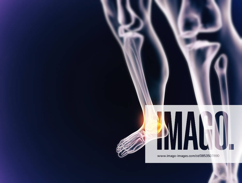 A cgi view of an inflamed joint isolated on blue (License=RF) ,model released, Symbolfoto