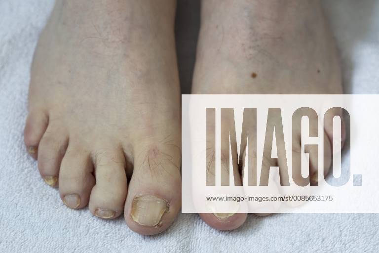 Feet toenails with nail fungus infestation
