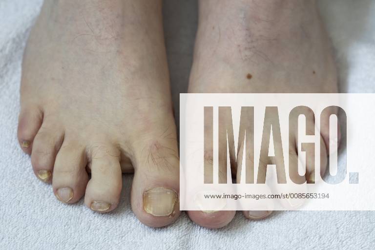 Feet toenails with nail fungus infestation