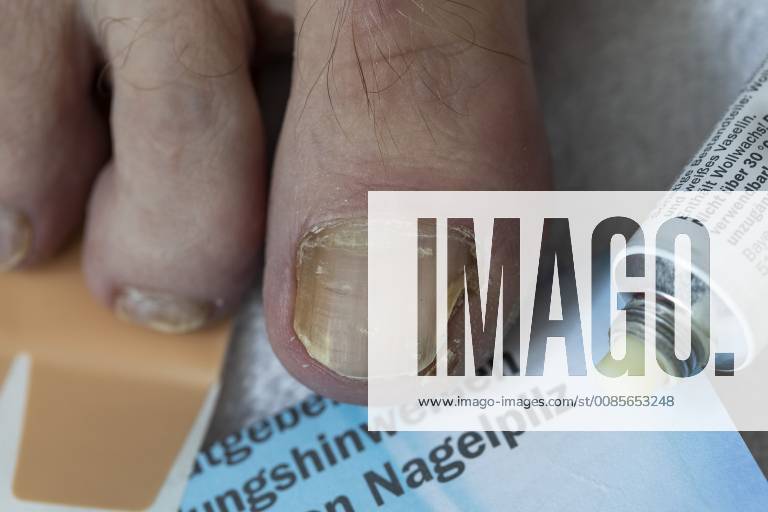 Toenails with nail fungus infestation ointment for treatment removal of the diseased nail bed
