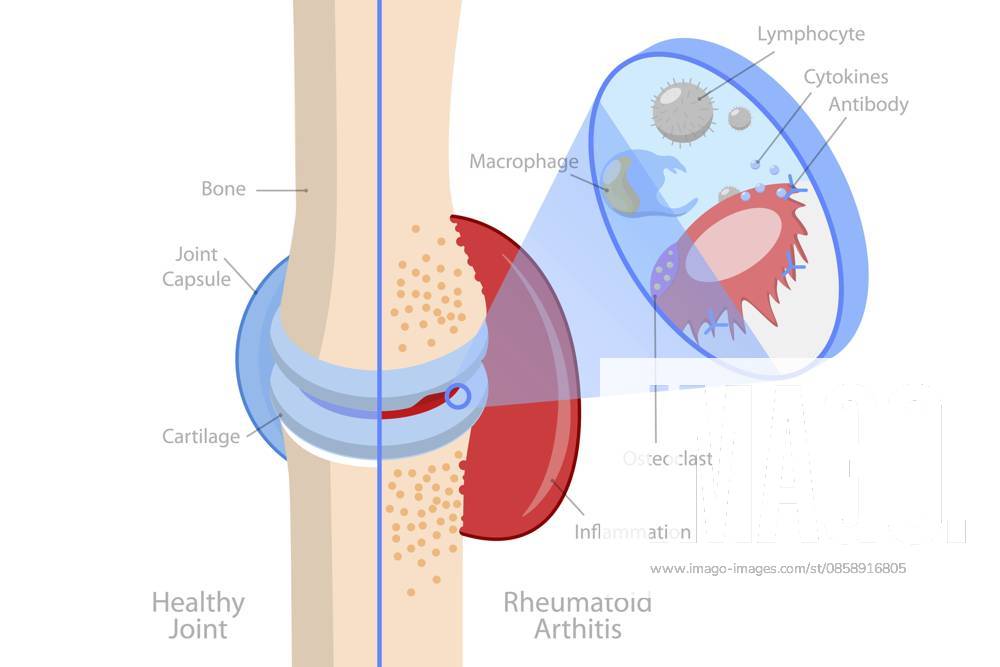 Isometrische flache konzeptionelle 3D Illustration von rheumatoider Arthritis, Knochenschmerzen, Verletzungen und Entzündungen 3D Isometric Flat Conceptual Illustration of Rheumatoid Arthritis, Bones Pain, Injury and Inflammation
