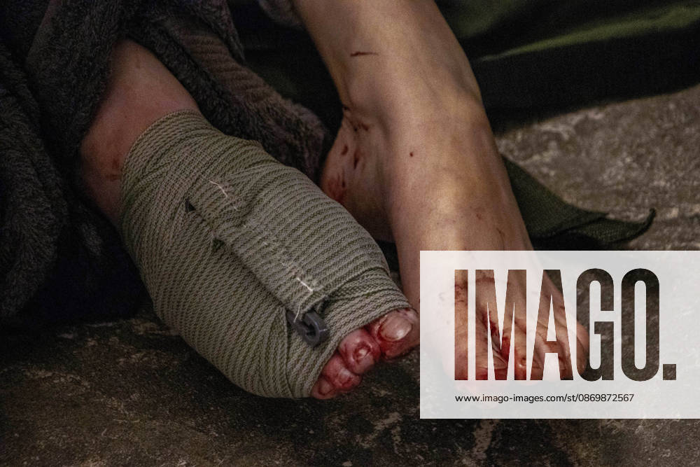 Odesa Ukraine Residential Fire A view shows the injured feet of a person rescued from a residential building in Odesa, Ukraine on October 18, 2026. Emergency services responded after a fire broke out at the building, prompting a rescue operation and deployment of firefighters to the scene. Odesa Odesa Ukraine
