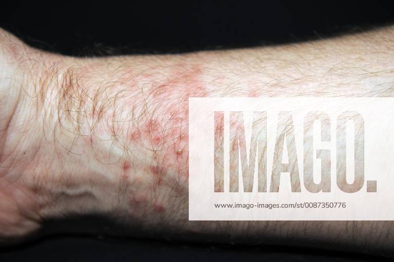 Strongly reddened blistered skin after netting with sea anemones Heteractis spec