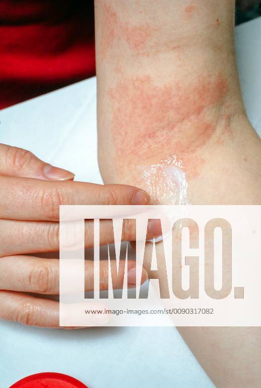 Woman wearing ointment at eczema at the elbow on Germany Europe