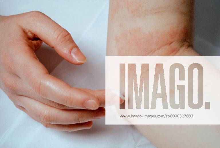 Woman wearing ointment at eczema at the elbow on Germany Europe