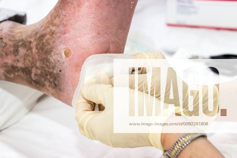 Nursing care at the diabetic foot with wound care diabetes care with wound treatment Nursing care at the diabetic foot with wound care diabetes care with wound treatment 1080700644