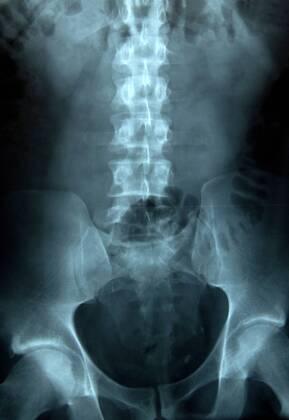 X-Ray of a Female Lumbar Vertibrae
