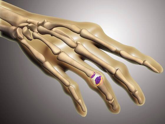 Conceptual image of rheumatoid arthritis (RA) in the human hand. RA is a chronic inflammatory disorder that typically affects the small joints in your hands and feet.  Copyright: StocktrekxImages STK701011H