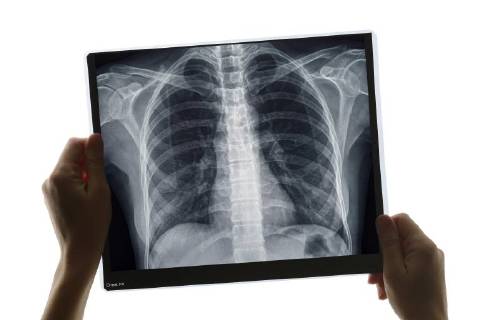 Diagnosis with chest X-ray Copyright: imageBROKER/SimonxBelcher ibxdig04631305.jpg