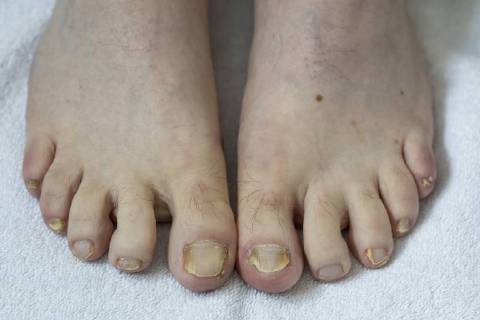 Feet toenails with nail fungus infestation