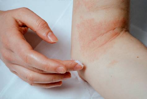 Woman wearing ointment at eczema at the elbow on Germany Europe Copyright: imageBROKER/UlrichxZillmann ibxuzi04859738