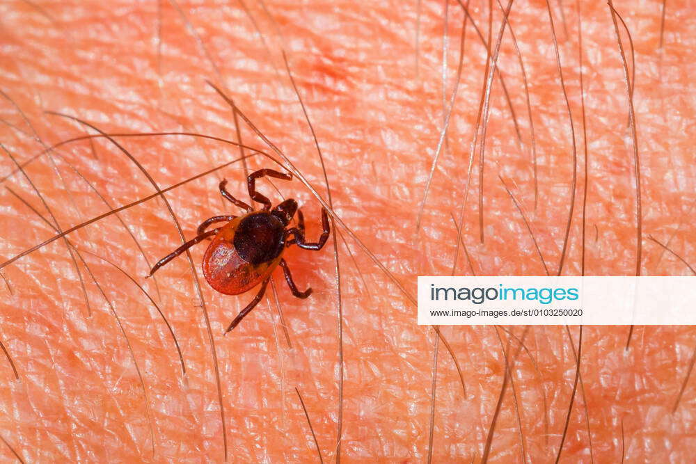 Zecke Gemeiner Holzbock Ixodes Ricinus Auf Haut Aufsicht Deutschland European Castor Bean Tick Eu