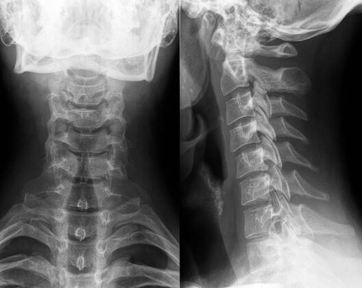 x ray,neck vertebrae,radiology,x-rays,xray,xrays 1un-gk8