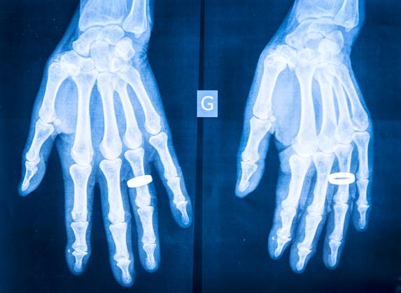 X-ray of rheumatism in the hands. Rheumatism 013843_010
