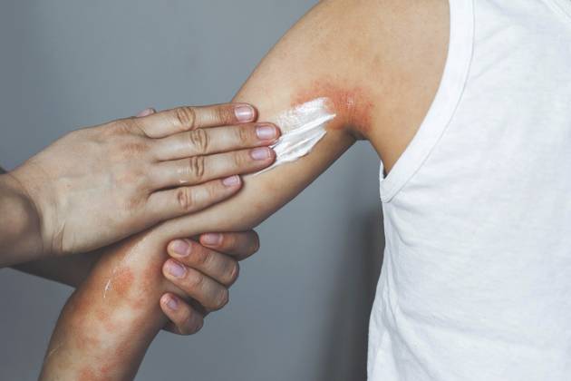 Psoriasis Day on 29 October
